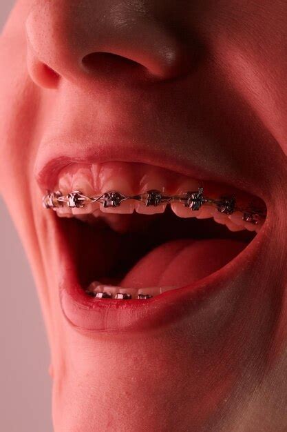 Premium Photo | Closeup of a womans mouth with braces on her teeth