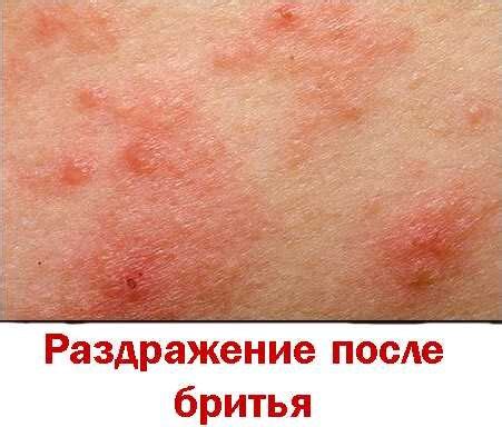 КАК ПОБЕДИТЬ РАЗДРАЖЕНИЕ ПОСЛЕ БРИТЬЯ? | Laser Bar Kiwi | Дзен
