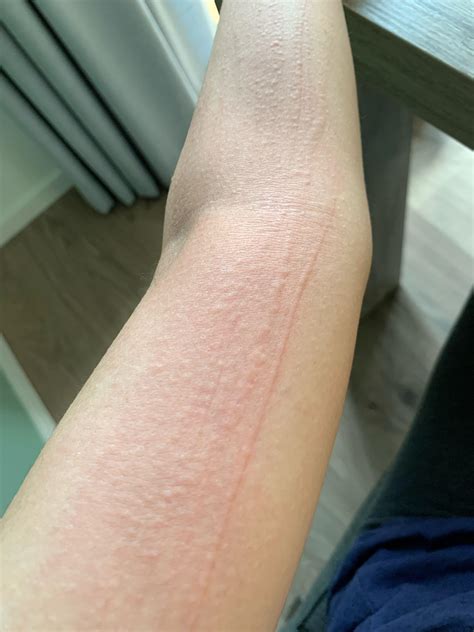 Skin reaction after scratch : r/DermatologyQuestions