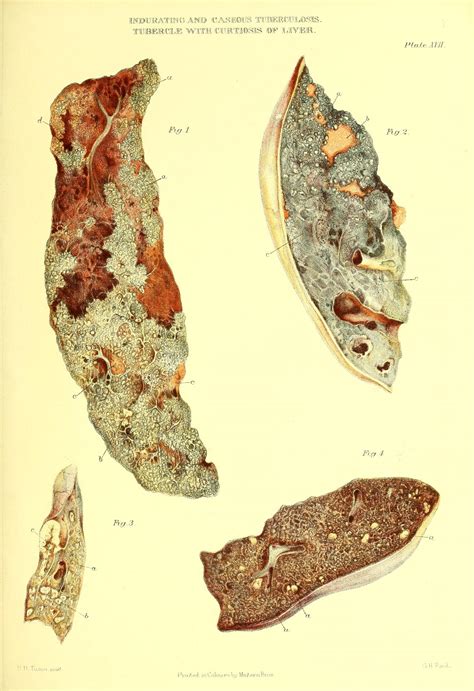 Atlas patološke anatomije pluća, 1888. godina. - Fascija.com