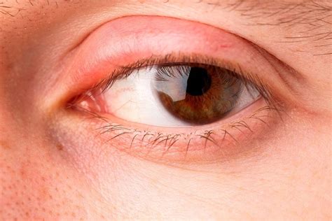Como curar el chalazión en el ojo: causas y tratamiento