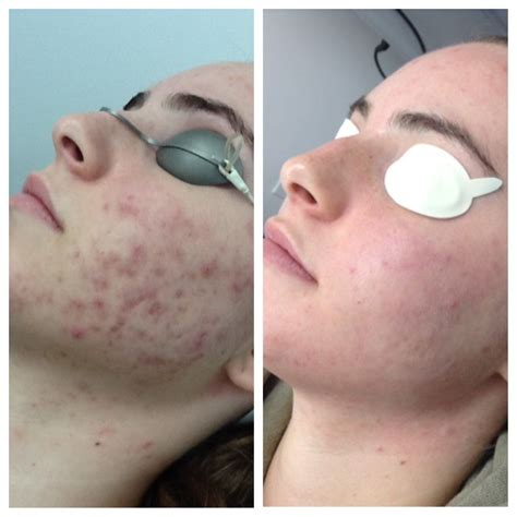 Clear And Brilliant Before And After Pores