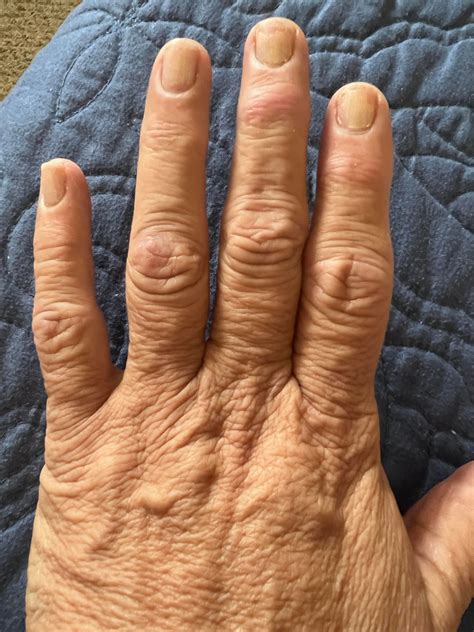 How can I stop the progression of my arthritis in my fingers : r/Thritis