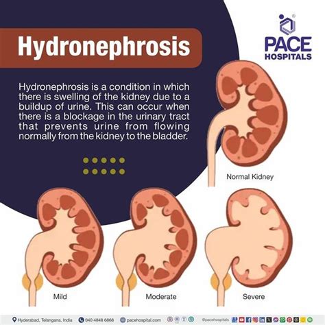 Hydronephrosis Meaning