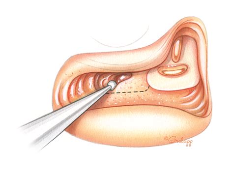 Endolymphatic Sac Surgery – Oto Surgery Atlas