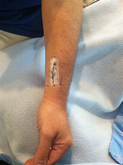 News and Views by Chris Barat: Hand Under Fistula