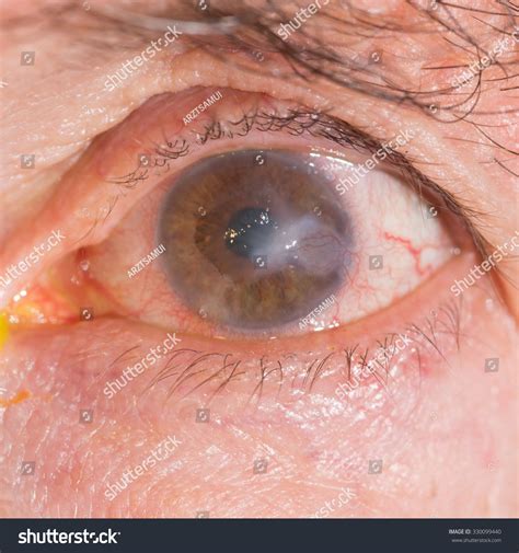 Close Interstitial Keratitis During Eye Examination Stock Photo