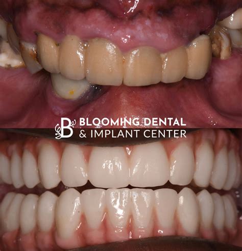 Before & After Photos | Blooming Dental & Implant Center | West ...