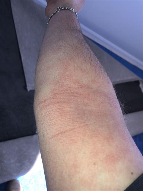 Need help, have this rash thing on my skin for the past 6 months. It’s