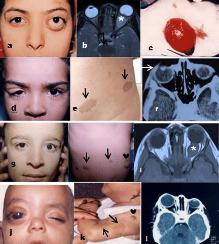 Neurogenic lesions: Optic nerve glioma. (a) A clinical photograph of a ...