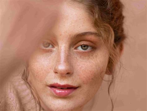 best treatment for face melasma 4