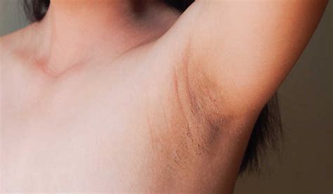 Axilas Escuras O Que Pode Ser - Axilas Escuras (Manchas Nas Axilas): Guia Completo Sobre Causas ...