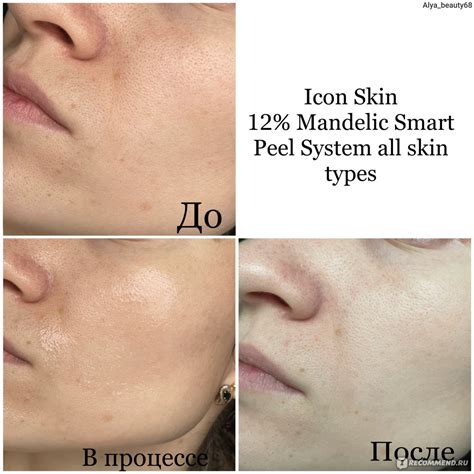 Пилинг для лица Icon Skin Миндальный 12% для всех типов кожи - «Для ...