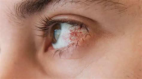 Keratitis Symptoms: Understanding the Signs of Corneal Inflammation