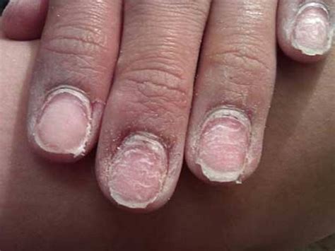 Уничтожает ногти: Названа главная опасность гель-лака Sensitive Skin ...