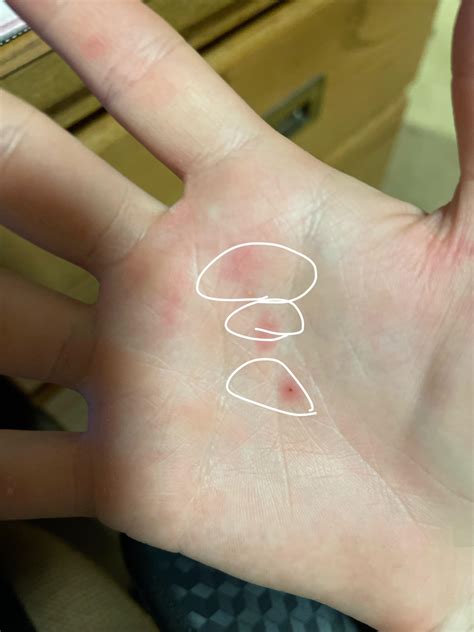 Itchy Bumps On Hands And Feet Pregnancy at Joseph Poulos blog