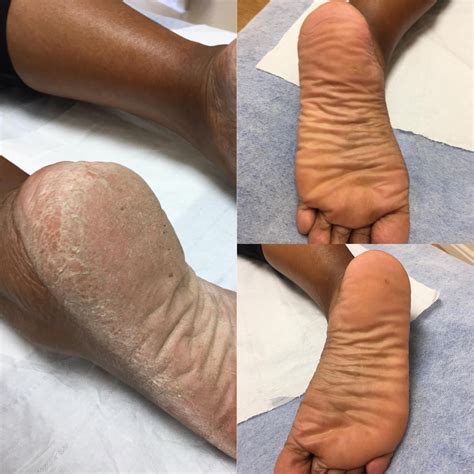 Callus Peel Treatment Leicester - Smooth Feet
