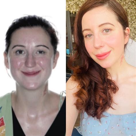 Makeup after Rhinoplasty : r/PlasticSurgery