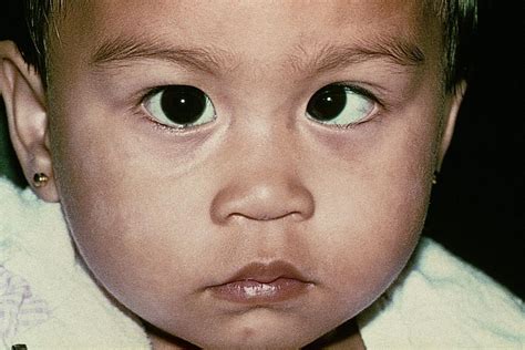 esotropia, esotropia question and answers | Firmoo Answers
