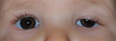 Congenital ptosis causes, symptoms, diagnosis & treatment