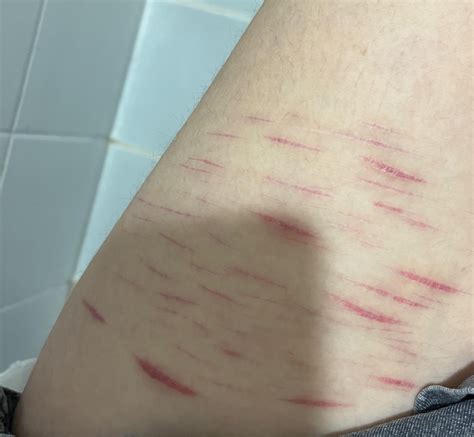 tw sh scars  long     turn white rscars