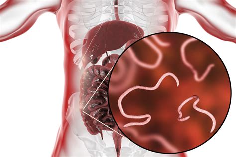 Signs of Parasites: The Top Signs You Have a Parasite in Your Stomach ...