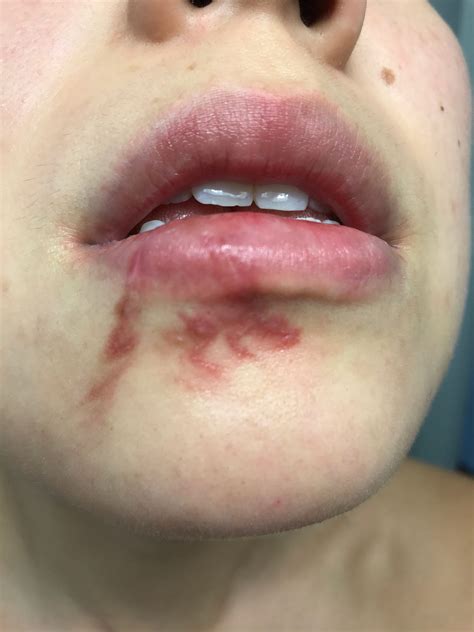 dog bite wound healing stages  paula young blog