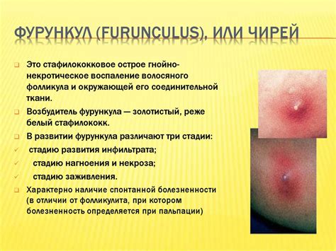 Пиодермиты. Стафилодермии - презентация онлайн