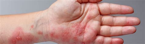 When Shingles Infects Your Eyes: Symptoms and Complications