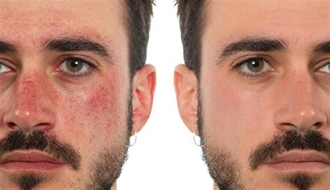 premium photo     treatment  rosacea   mans face
