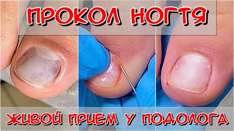 Прокол ногтя / зачем прокалывать ноготь / Подология / Живой прием ...