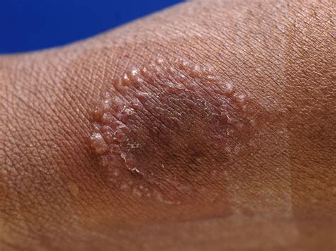 Ringworm Rash Image Pictures Photos - vrogue.co