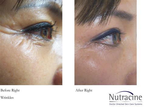 Tretinoin Before And After Wrinkles | www.imgkid.com - The | Hair