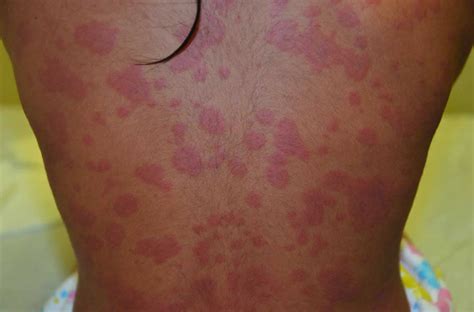 Urticaria And Skin Rashes Signs Causes Treatment Symptoms Images Images