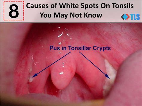 PPT - 8 Causes of White Spots On Tonsils You May Not Know PowerPoint
