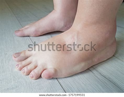 295 Edema Water Images, Stock Photos & Vectors | Shutterstock