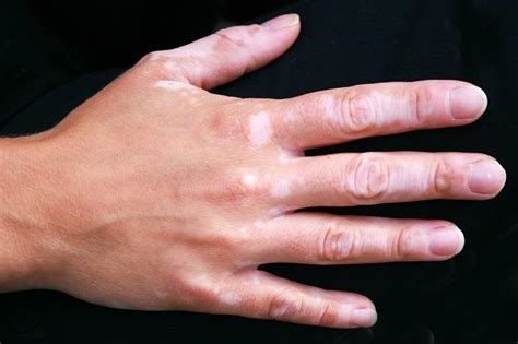 Kenali 5 Penyebab Bercak Putih pada Kulit - Alodokter