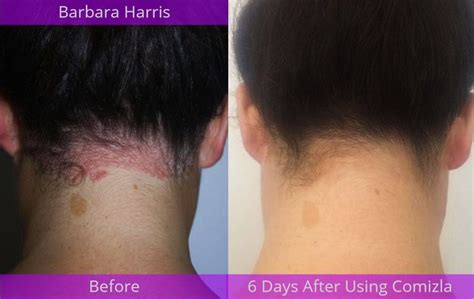 Comizla Psoriasis Cream – Stem Cell Therapy For Psoriasis