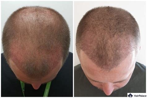 hair transplant infection symptoms - Waltraud Muncy