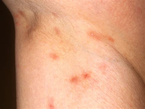 rashes    scabies  symptoms