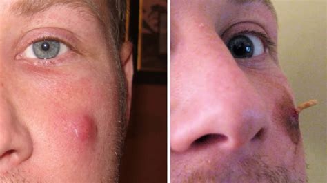 What Does The Inside Of A Zit Look Like at James Ferrell blog