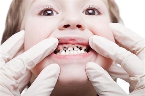 Почему чернееют зубы? Что делать если почернели зубы