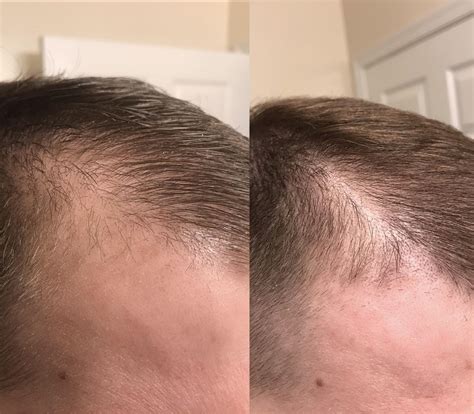 Folliculitis after facial threading : r/Folliculitis