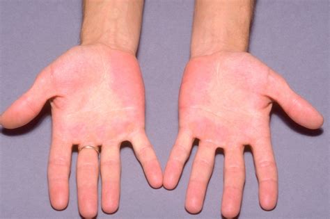 Eritromelalgia - Condiciones 2024