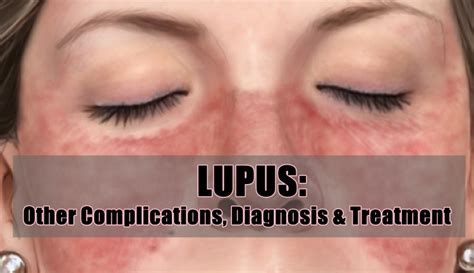 LUPUS: Other Complications, Diagnosis & Treatment