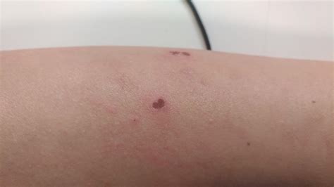 Had a mosquito bite last night, scratched it. Now it's turned into a