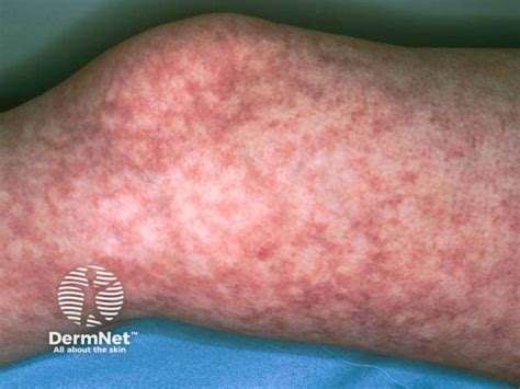 Sjögren syndrome image