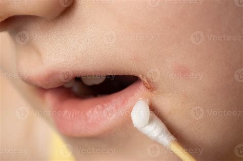 Treatment with ointment for a dermatological disease in the corners of