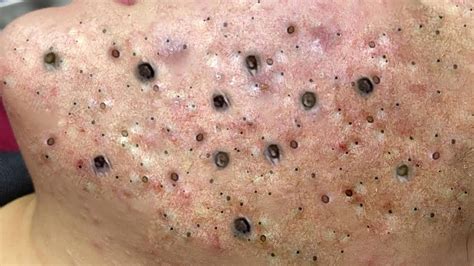 suri nguyen acne treatment blackheads whiteheads removal cyst pimple ...