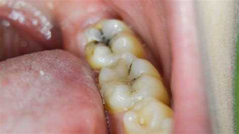 Tooth Cavity Xray